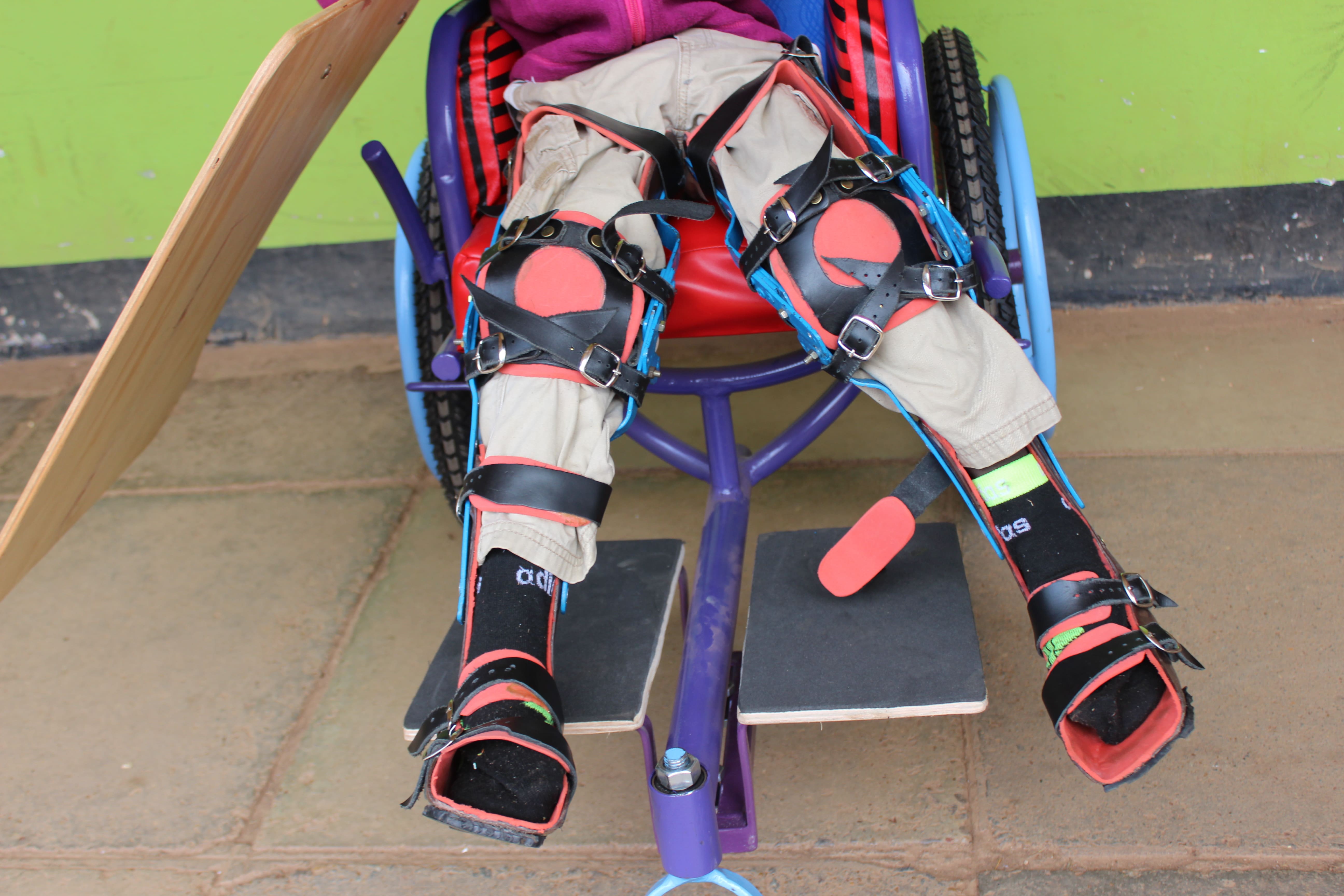 Knee Ankle Foot Orthosis (KAFO)